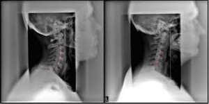 CervicalAlignmentXrays